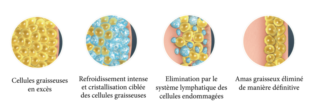 cryolipolyse